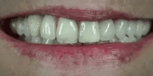 NovaBright Snap-On Veneers, Instant Smile Cover For Upper Or Lower Teeth