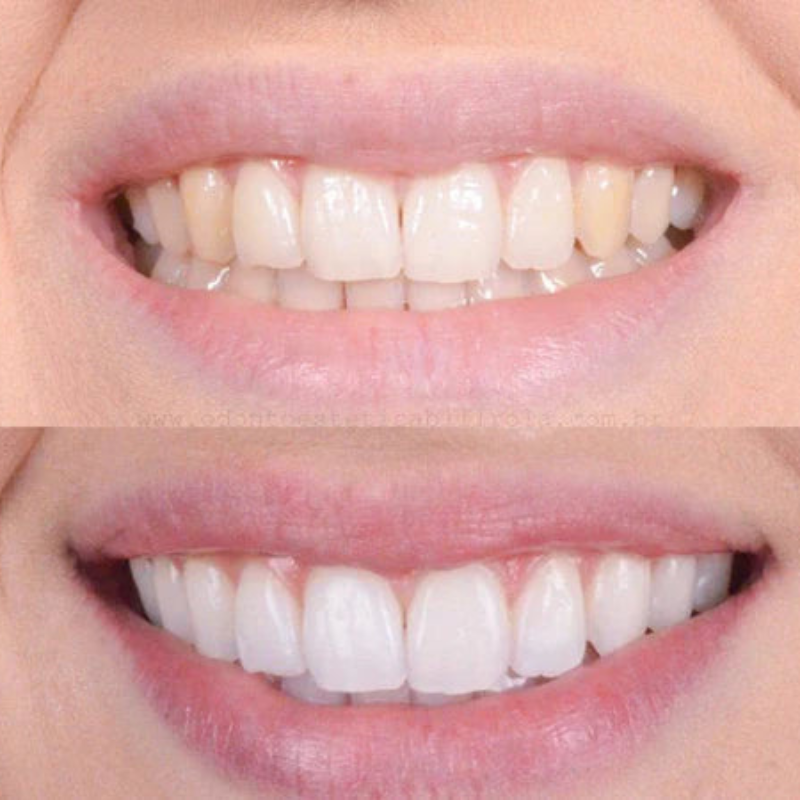 Swift Pro Edition Clareamento Rápido dos Dentes para um Sorriso Mais Brilhante
