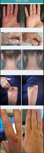 308-nm-UVB-Phototherapielampe mit drei austauschbaren Lampenschirmen