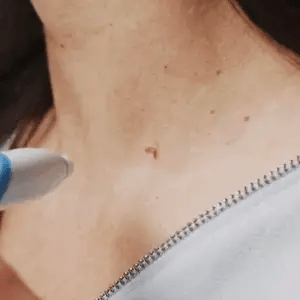 LumaDerm Skin Tag Removal Kit With A Targeted Applicator At Home Use