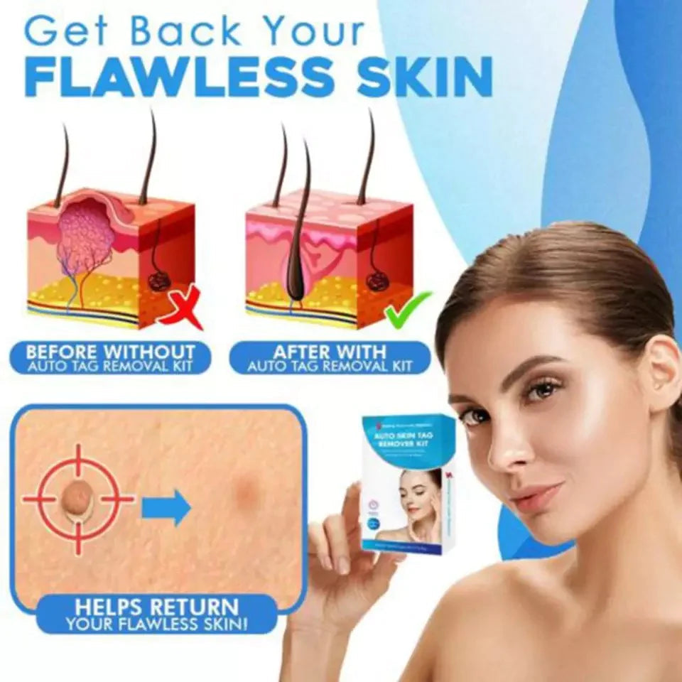 LumaDerm Skin Tag Removal Kit With A Targeted Applicator At Home Use