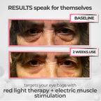 Dispositivo RadianceLift para a zona sob os olhos com luz vermelha e terapia de microcorrentes