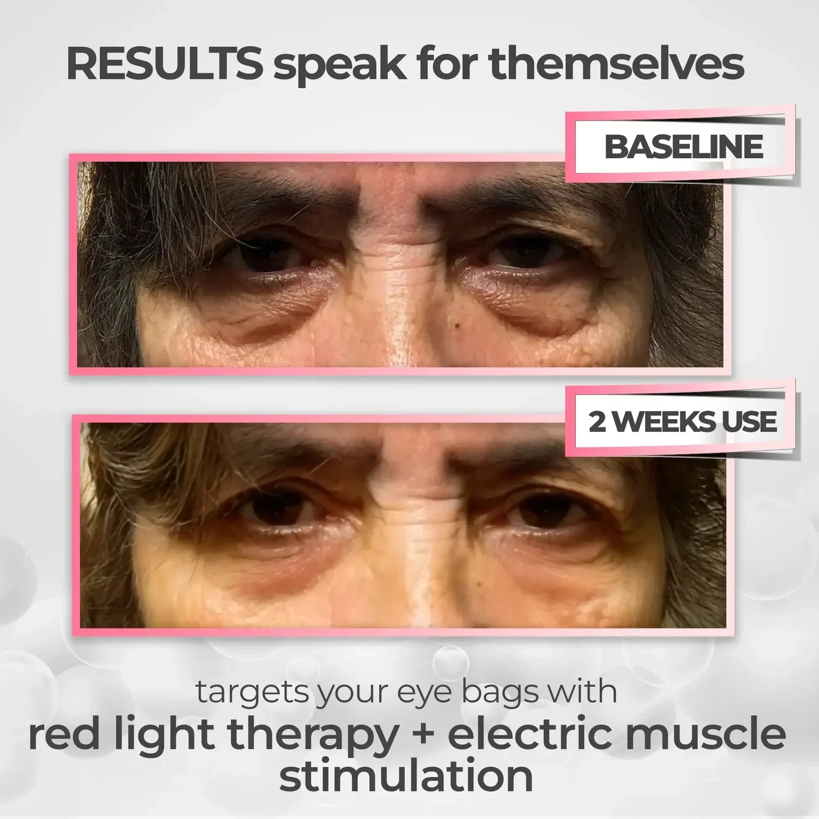 Dispositivo RadianceLift para a zona sob os olhos com luz vermelha e terapia de microcorrentes