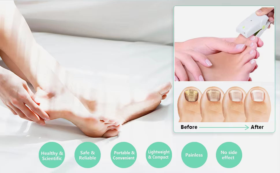 NovaNail Home Nail Fungus Laser For Fingers And Toes