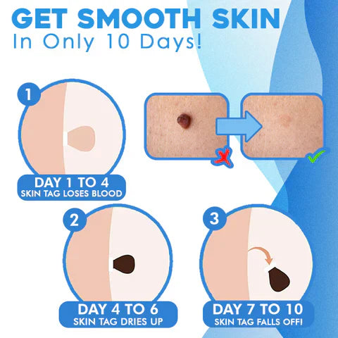 LumaDerm Skin Tag Removal Kit With A Targeted Applicator At Home Use