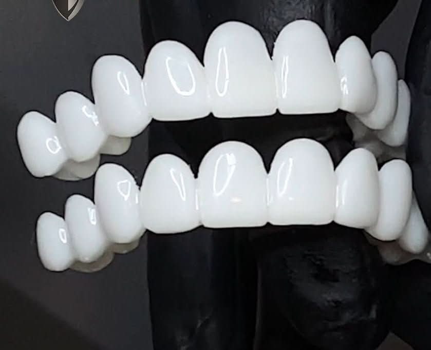 Tandprothese met witte tandlenzen - Fioriscas