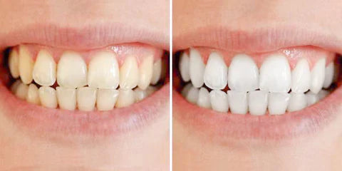 Swift Pro Edition Clareamento Rápido dos Dentes para um Sorriso Mais Brilhante