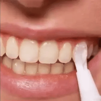 Swift Pro Edition Clareamento Rápido dos Dentes para um Sorriso Mais Brilhante