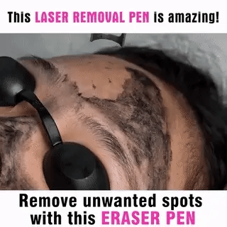 LumiDerm At-Home Laser Pen For Tattoos And Skin Spots