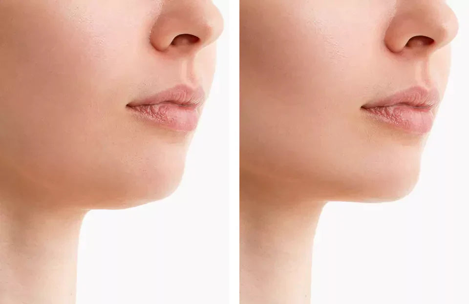 ChinContour NovaLume světelný zábal na čelist s červeným světlem, bez kabelu, 4 režimy