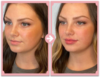 Poutify Lip Plumping Booster Kit Plus Edition For Fuller Lips