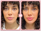Poutify Lip Plumping Booster Kit Plus Edition For Fuller Lips