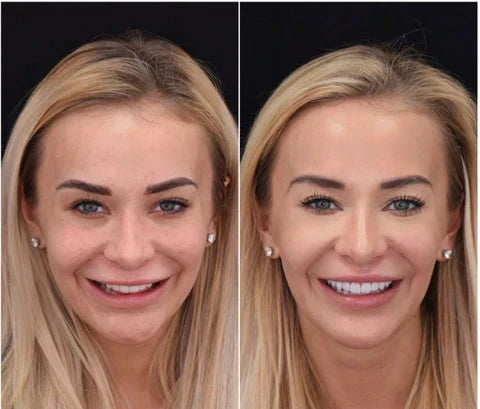NovaBright Snap-On Veneers, Instant Smile Cover For Upper Or Lower Teeth