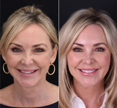NovaBright Snap-On Veneers, Instant Smile Cover For Upper Or Lower Teeth