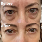 Dispositivo RadianceLift para a zona sob os olhos com luz vermelha e terapia de microcorrentes